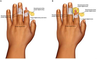 The Clinical Effect of Digital Dorsal Fascial Island Flap Combined With Crossfinger Flap for Repairing Distal Degloving Injury and Sensory Reconstruction